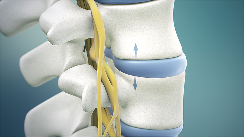 What Is Spinal Decompression Therapy?